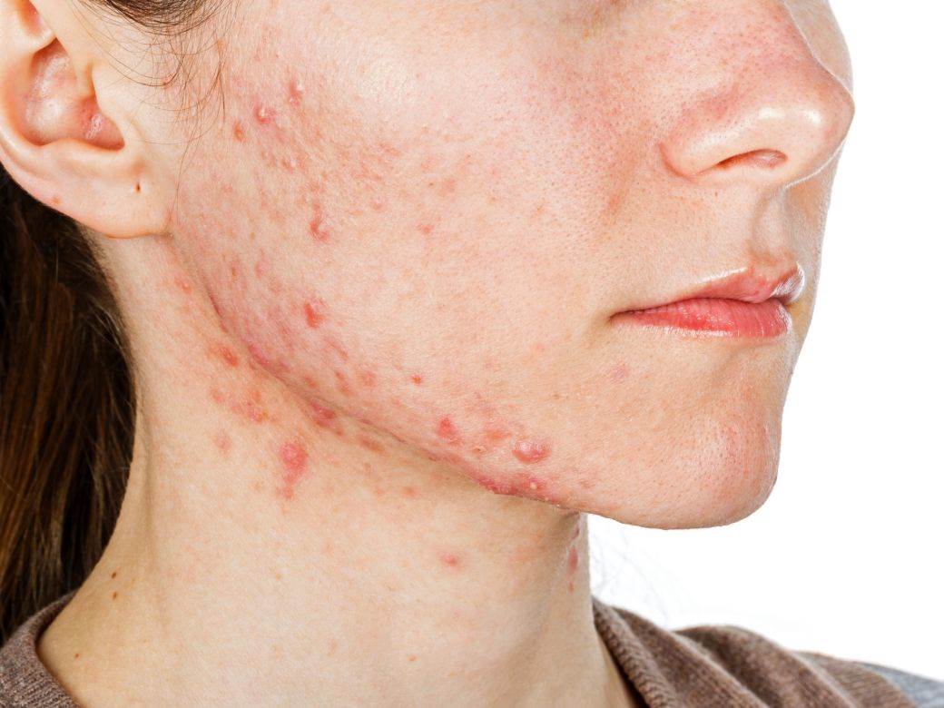  I osip po koži može da bude simptom zaraze koronom? 