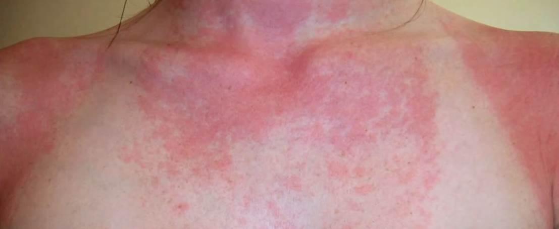  Četiri znaka da možda imate alergiju na sunce! Ove simptome ne smijete ignorisati! 