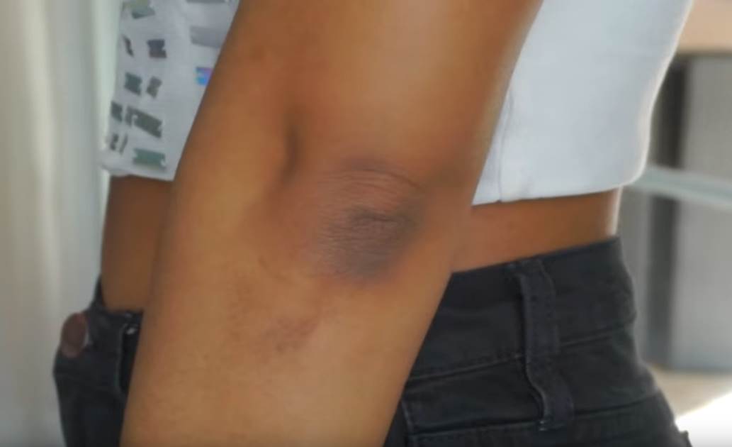  Simptomi bolesti na laktovima 