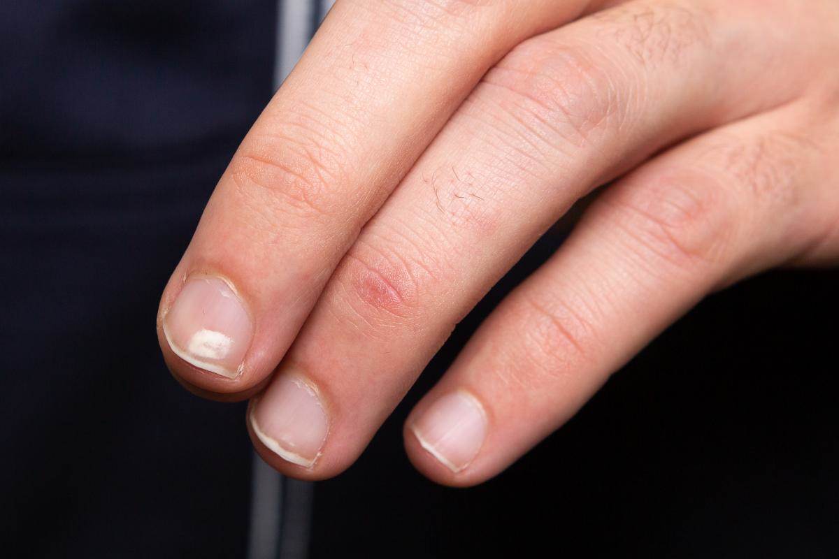  Šta uzrokuje bijele mrlje na noktima 
