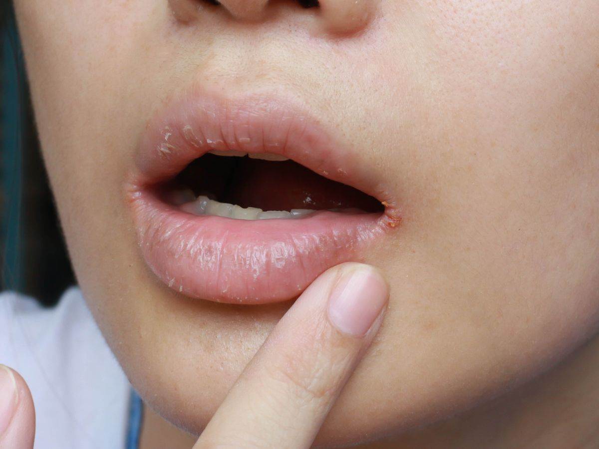 Ispucale usne simptom anemije 