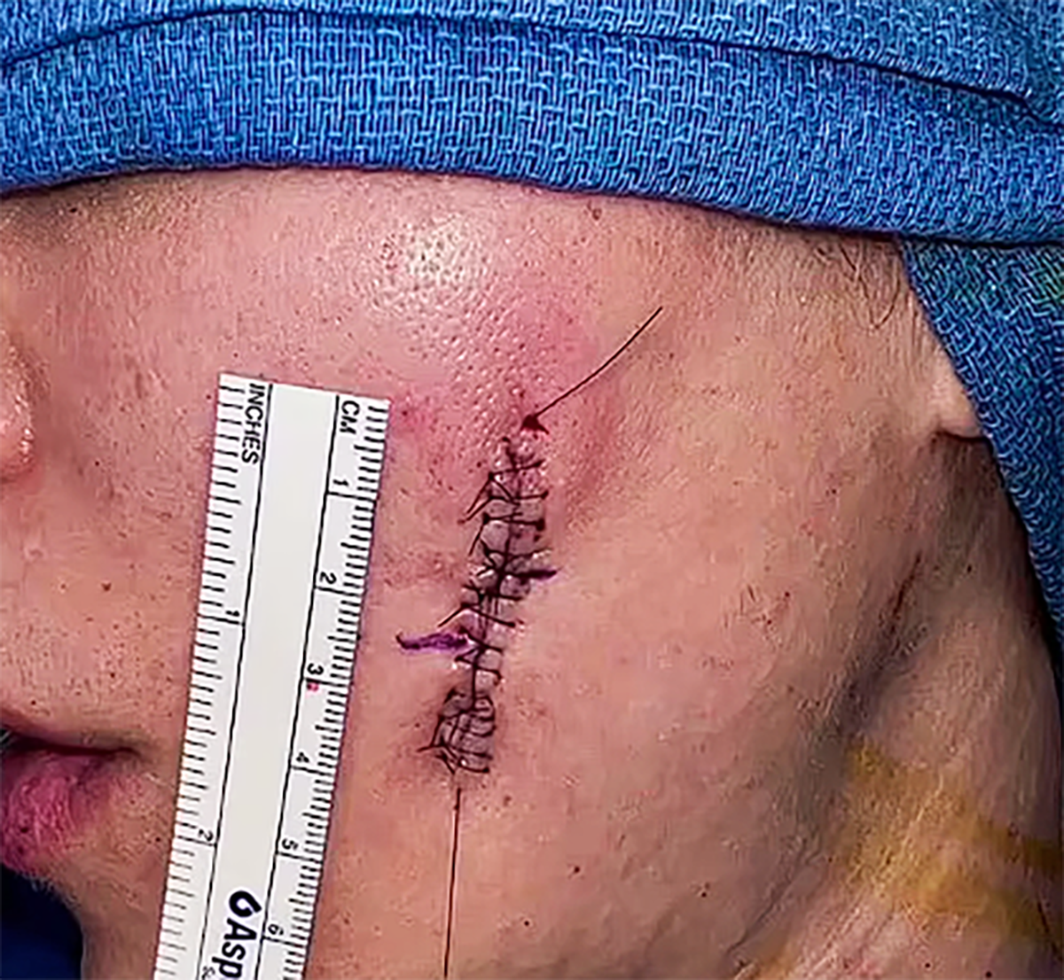 Kloi Kardašijan dva puta operisala rak kože Kloi Kardašijan dva puta operisala rak kože