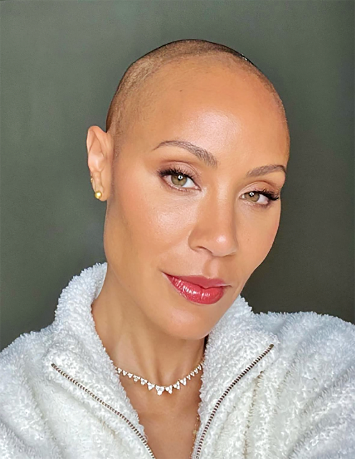 Džejda Smit o alopeciji Džejda Smit o alopeciji