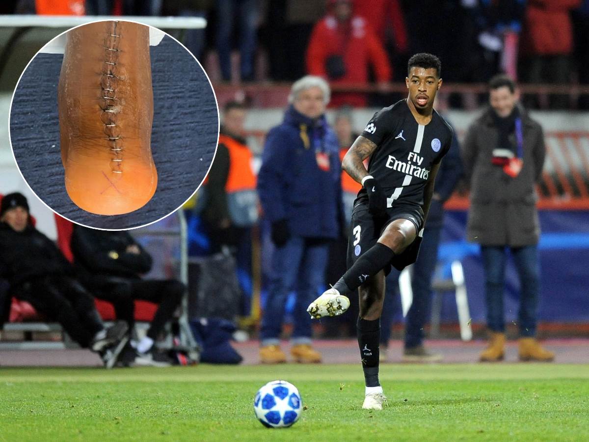  Presnel Kimpembe pokazao užasnu povredu 