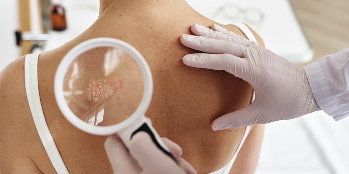  Psorijaza oboljenje i liječenje  