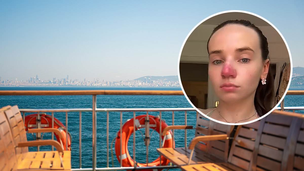  pet godina bez dijagnoze za crvenilo na nosu 