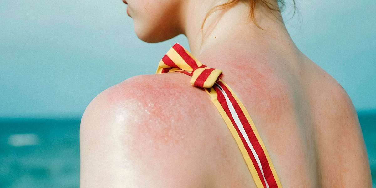  Šta je solarna urtikarija hemofarm 