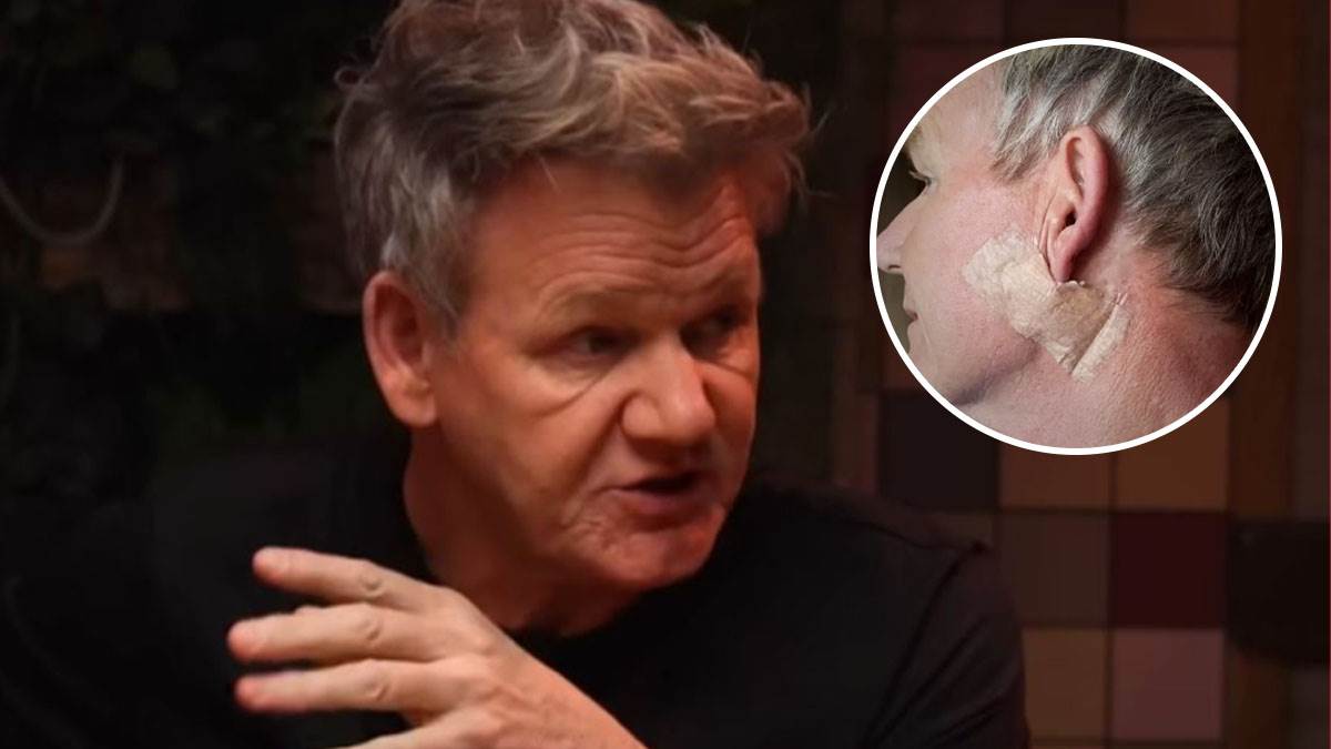  Gordon Remzi operisao karcinom kože 