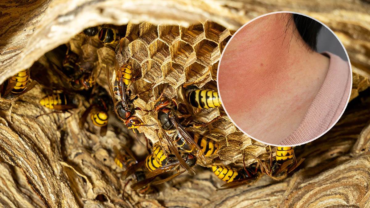  Šta prvo uraditi kada ujede stršljen 