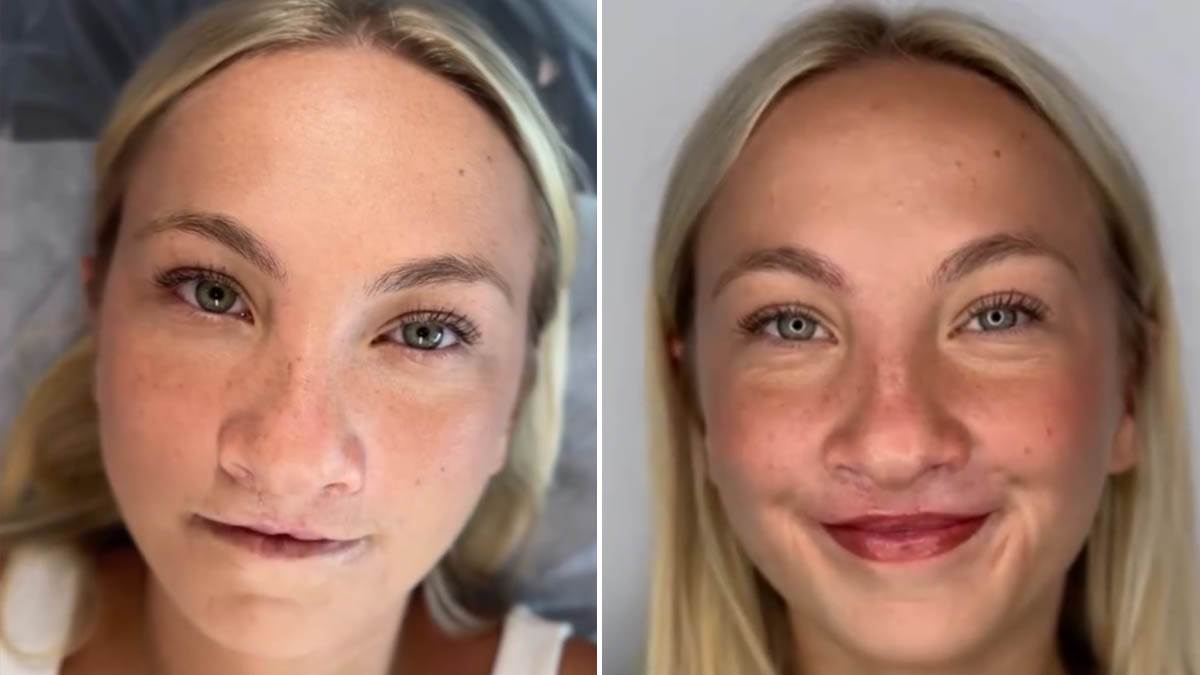  transformacija nakon operacije zečije usne 