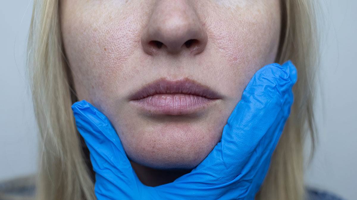  Znakovi na koži koj ukazuju da previše jedete šečer i mlijeko 