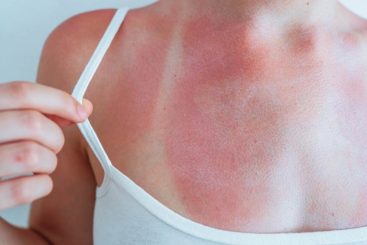  Opekotine od sunca: Šta uraditi odmah i kako zaštititi kožu 