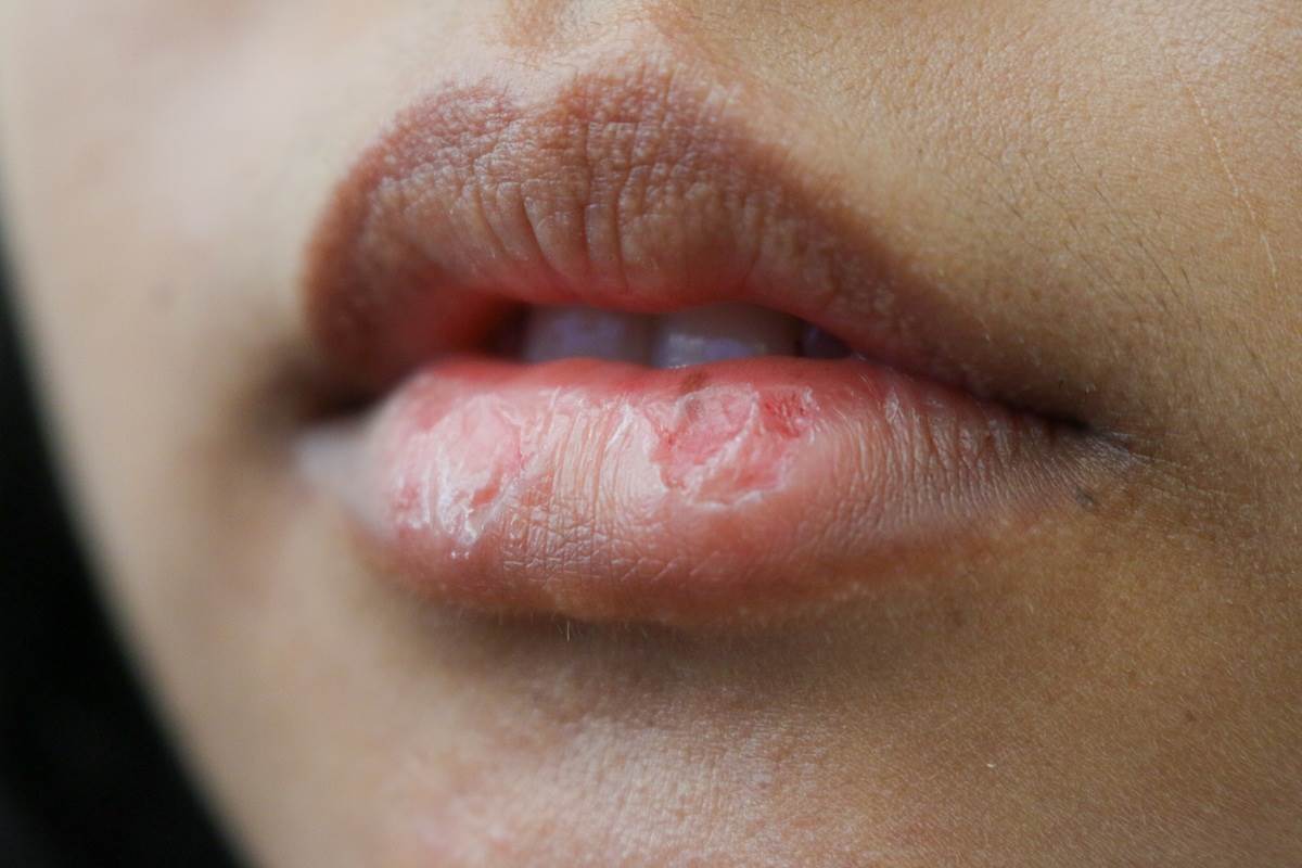  Kako izliječiti suve i ispucale usne: Trik dermatologa i greške koje pravimo 