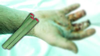  dječaku iz osijeka odsječena dva prsta nakon nesreće s petardom 