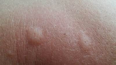  Prepoznajte: Kada je osip simptom raka 