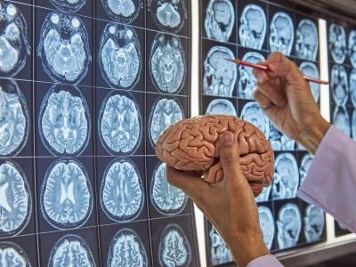  Test profesora neurologije otkriva da li  ste u riziku od Alchajmera 