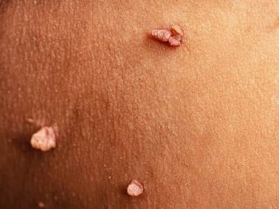  Rešite se bradavica bez muke: 5 domaćih lekova koje već imate kod kuće 