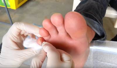  Aspirin liječi i žuljeve - evo kako! 