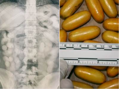  Ovako izgleda stomak pun kokaina: Brazlika (28) pokušala da prokrijumčari kilogram droge u Hrvatsku! 