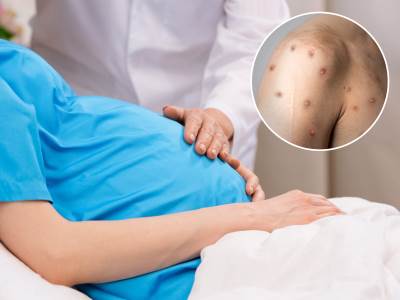  Trudnica zaražena majunskim boginjama dobila zdravu bebu 