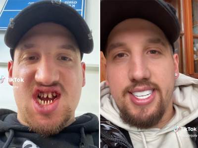  Vještački zubi prije i poslije ugrađivanja 