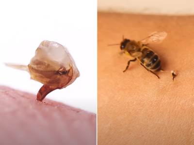  Šta se dešava u tijelu nakon ujeda pčele 