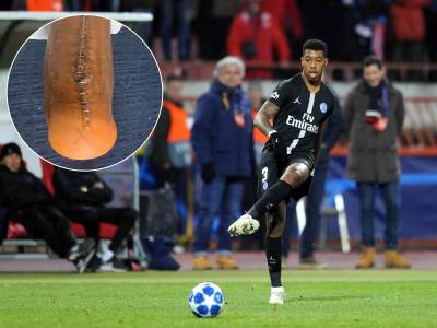  Presnel Kimpembe pokazao užasnu povredu 