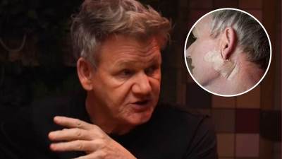  Gordon Remzi operisao karcinom kože 