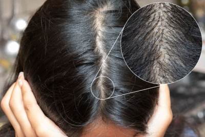  kako spriječiti opadanje kose 