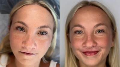  transformacija nakon operacije zečije usne 