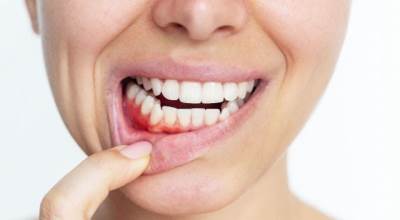  Kako izliječiti gingivitis  